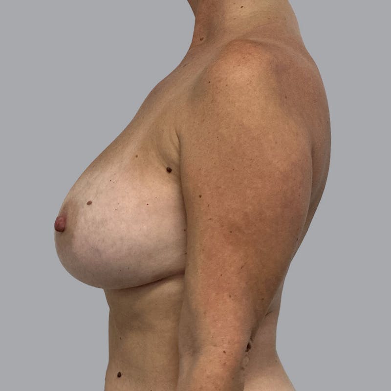 Breast Implant Removal Before & After Gallery - Patient 176745046 - Image 9