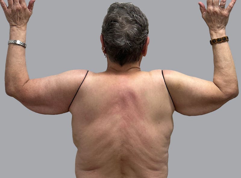 Arm Lift Before & After Gallery - Patient 188107358 - Image 1