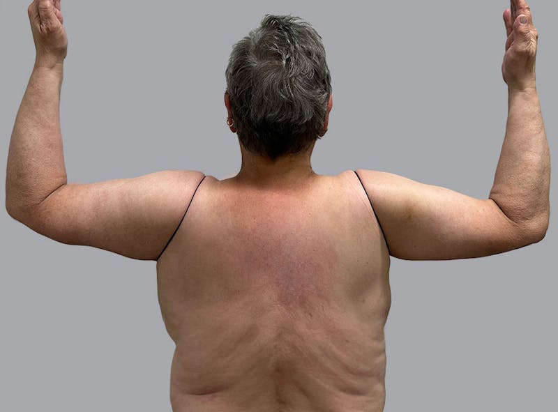 Arm Lift Before & After Gallery - Patient 188107358 - Image 2