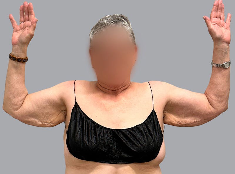 Arm Lift Before & After Gallery - Patient 188107358 - Image 3