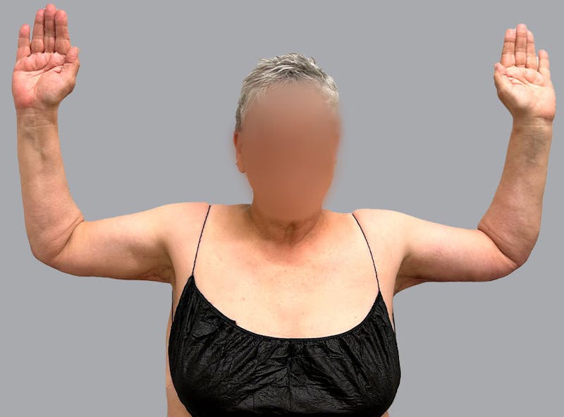 Arm Lift Before & After Gallery - Patient 188107358 - Image 4