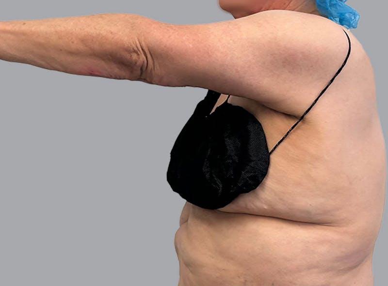 Arm Lift Before & After Gallery - Patient 188107358 - Image 6