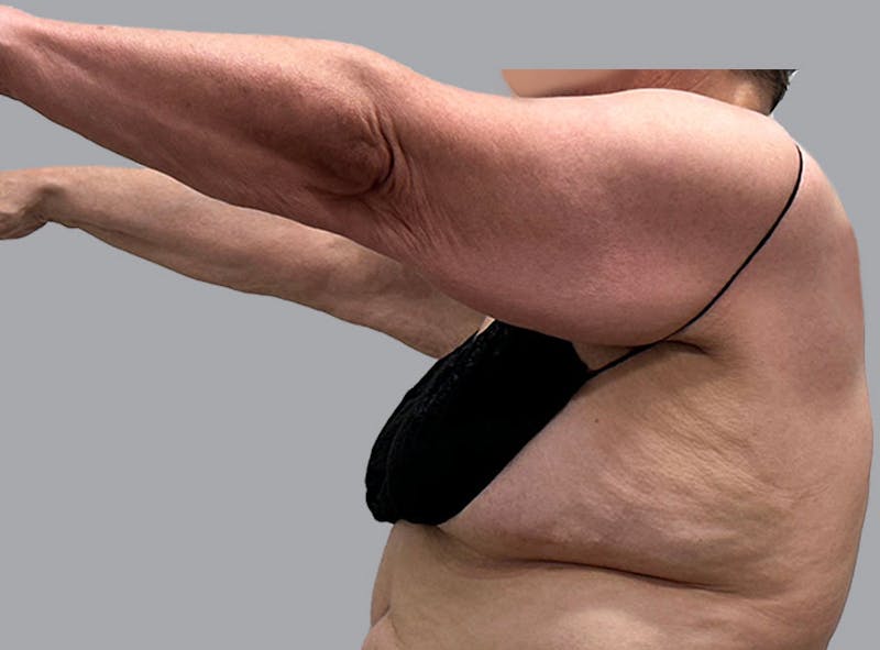 Arm Lift Before & After Gallery - Patient 188107358 - Image 5