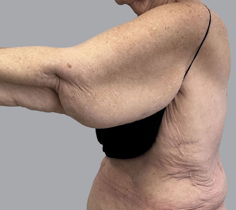 Arm Liposuction Before & After Gallery - Patient 120660 - Image 5