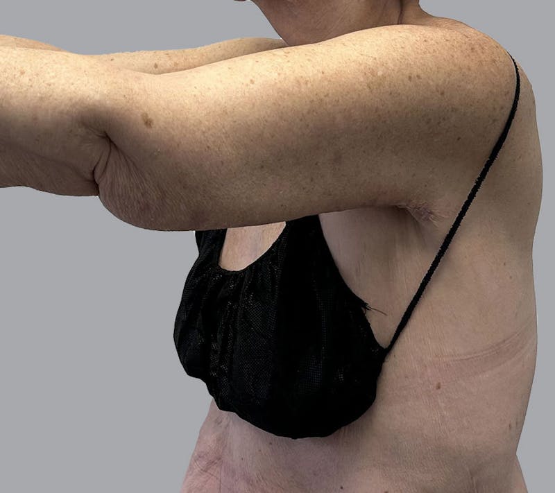 Arm Liposuction Before & After Gallery - Patient 120660 - Image 6