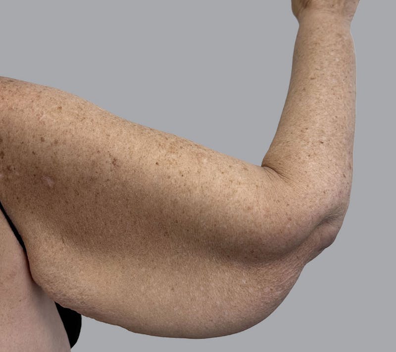 Arm Lift Before & After Gallery - Patient 188140127 - Image 7