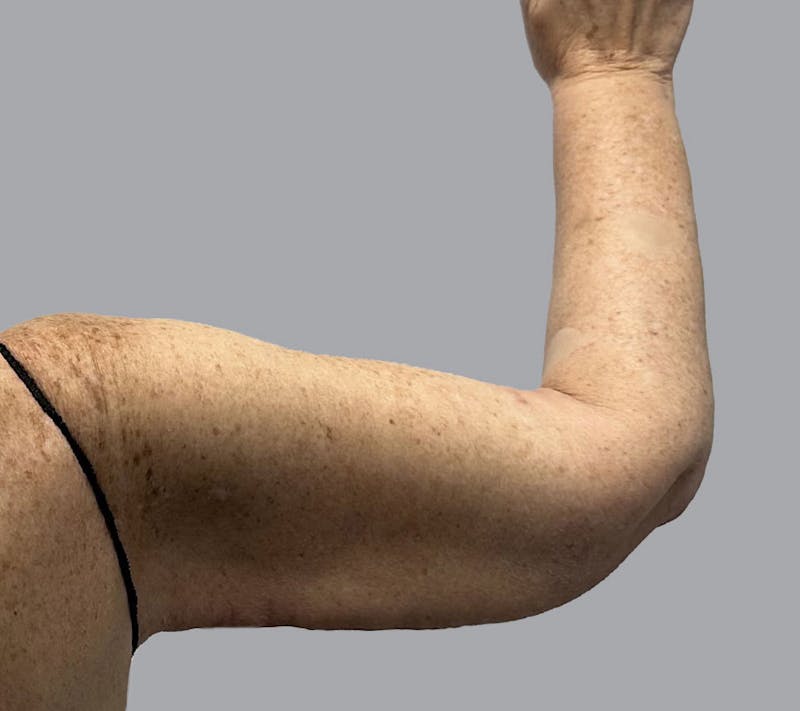 Arm Liposuction Before & After Gallery - Patient 120660 - Image 8