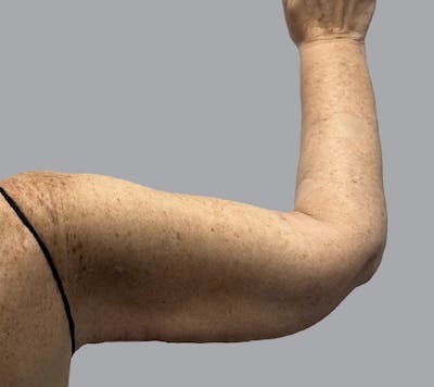 Lipedema Before & After Gallery - Patient 272789 - Image 8