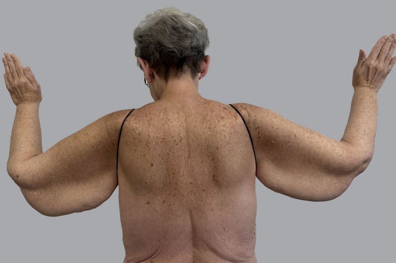 Arm Liposuction Before & After Gallery - Patient 120660 - Image 1
