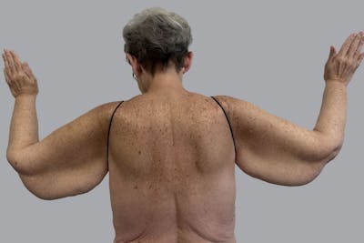 Lipedema Before & After Gallery - Patient 272789 - Image 1