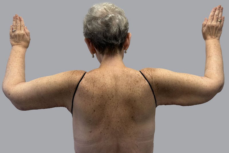Arm Liposuction Before & After Gallery - Patient 120660 - Image 2