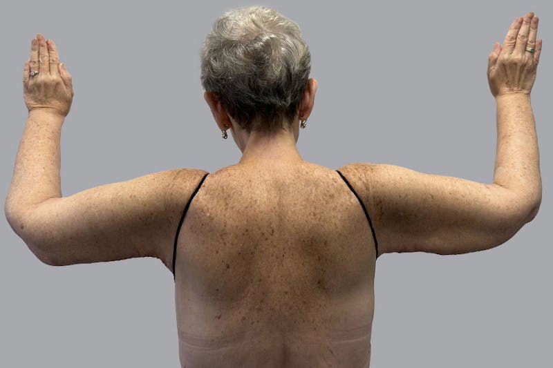 Arm Lift Before & After Gallery - Patient 188140127 - Image 2