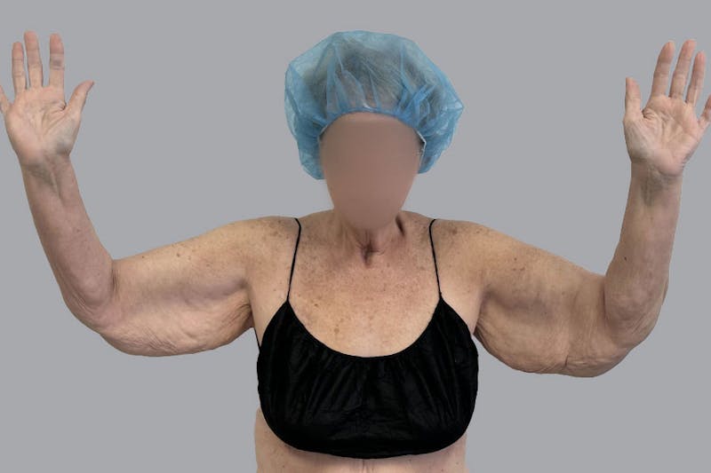 Arm Liposuction Before & After Gallery - Patient 120660 - Image 3