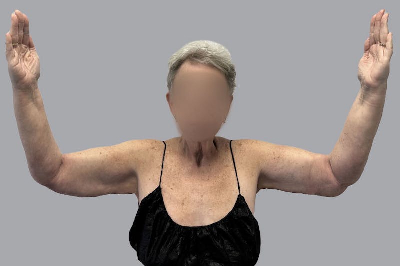 Arm Liposuction Before & After Gallery - Patient 120660 - Image 4