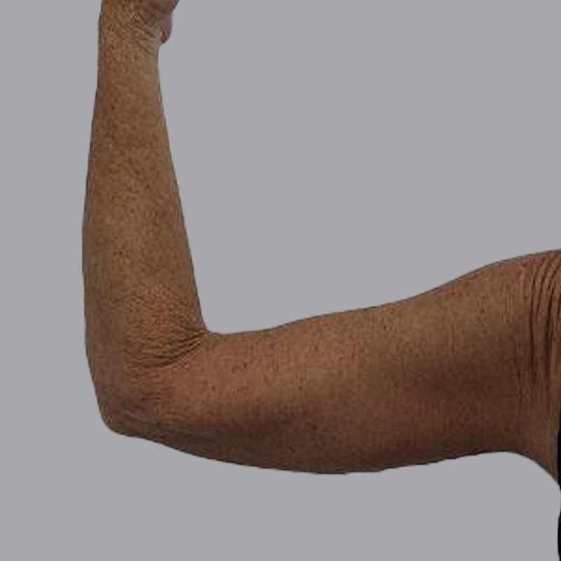 Arm Lift Before & After Gallery - Patient 189560825 - Image 4