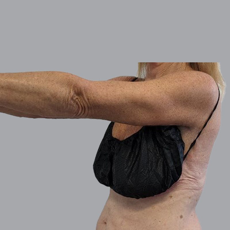 Arm Lift Before & After Gallery - Patient 189560825 - Image 6