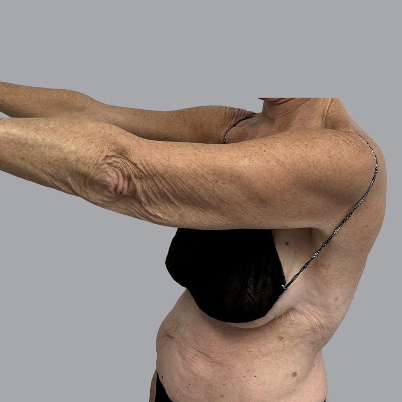 Arm Lift Before & After Gallery - Patient 189560825 - Image 5