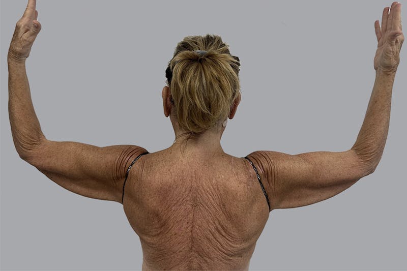Arm Lift Before & After Gallery - Patient 189560825 - Image 1