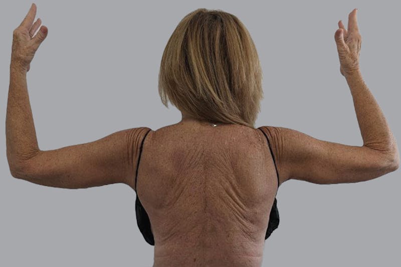 Arm Lift Before & After Gallery - Patient 189560825 - Image 2