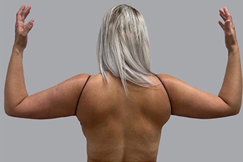 Arm Liposuction Before & After Gallery - Patient 232685 - Image 1