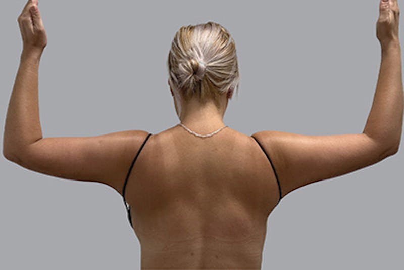 Arm Liposuction Before & After Gallery - Patient 232685 - Image 2