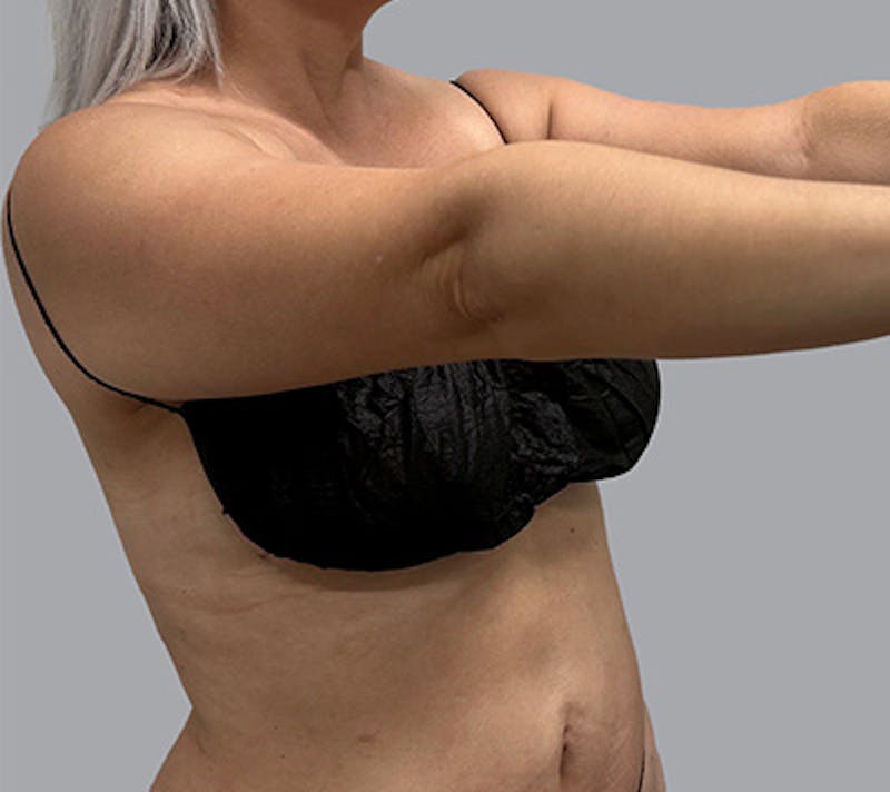 Arm Liposuction Before & After Gallery - Patient 232685 - Image 3