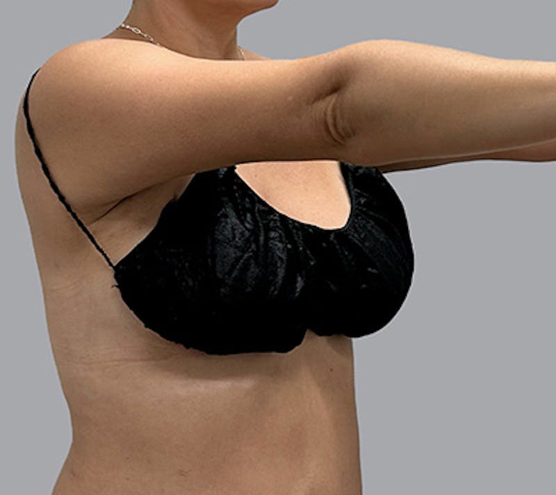 Arm Liposuction Before & After Gallery - Patient 232685 - Image 4