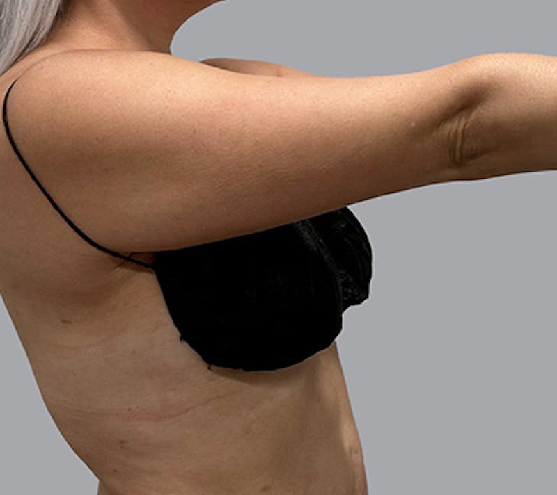 Arm Liposuction Before & After Gallery - Patient 232685 - Image 5
