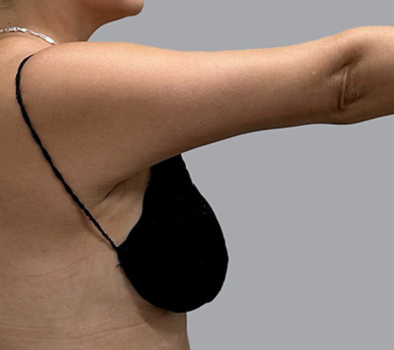 Arm Liposuction Before & After Gallery - Patient 232685 - Image 6