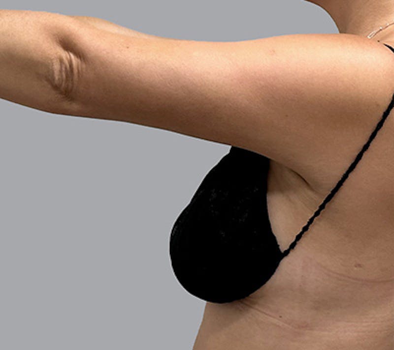 Arm Liposuction Before & After Gallery - Patient 232685 - Image 8