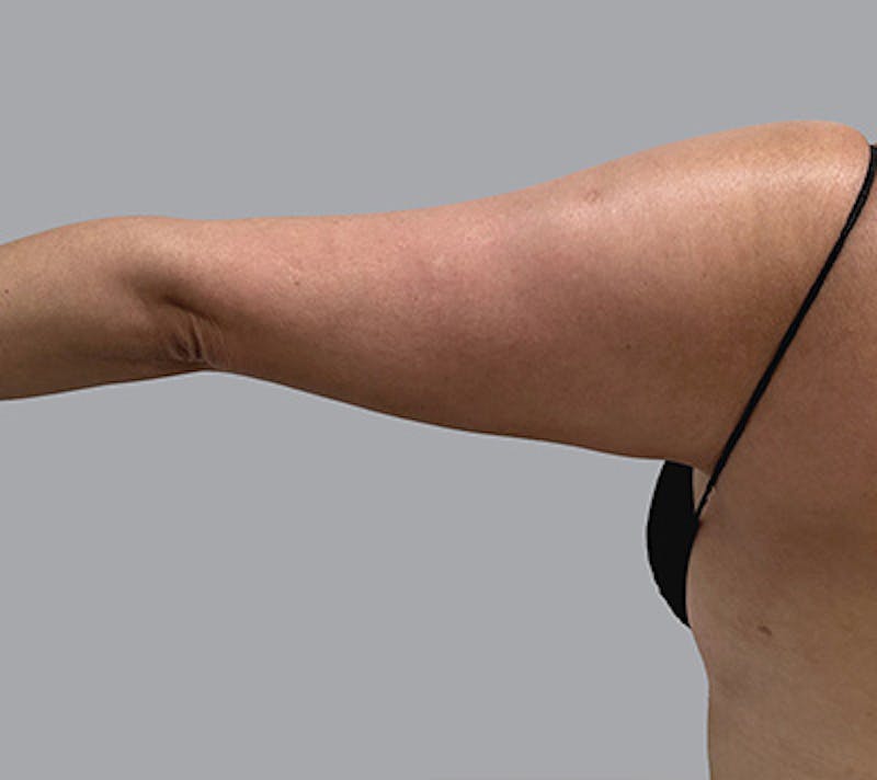 Arm Liposuction Before & After Gallery - Patient 232685 - Image 9