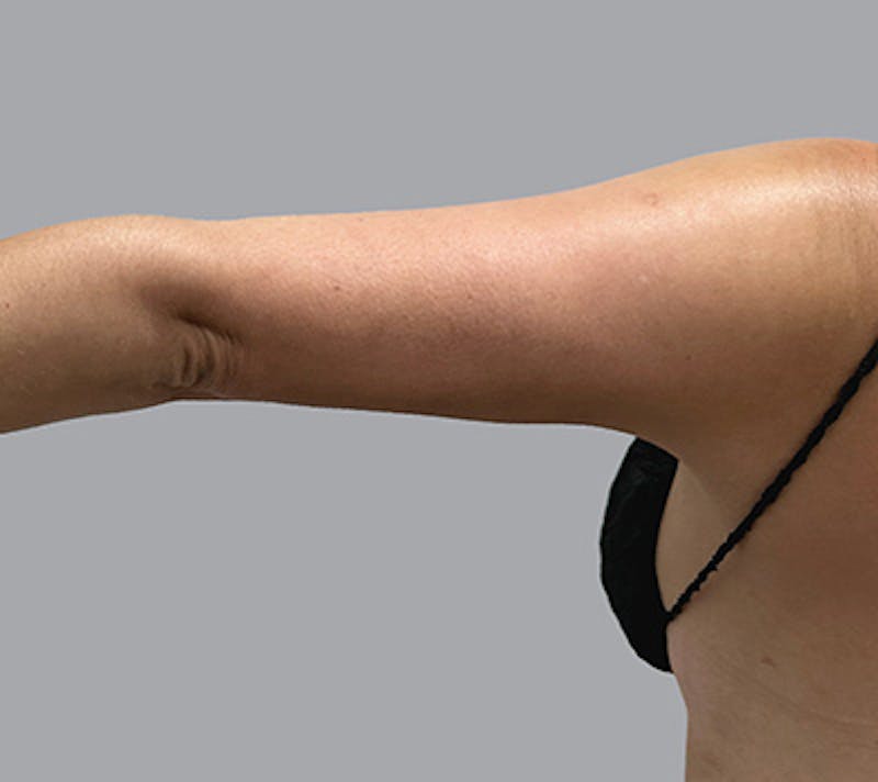 Arm Liposuction Before & After Gallery - Patient 232685 - Image 10
