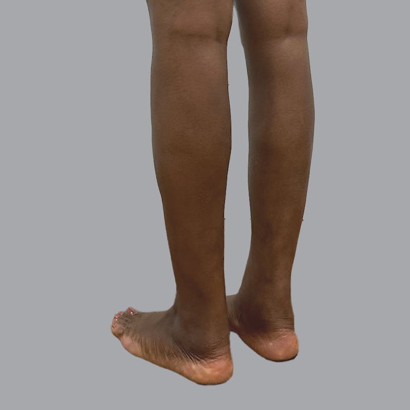 Leg Liposuction Before & After Gallery - Patient 422345 - Image 2