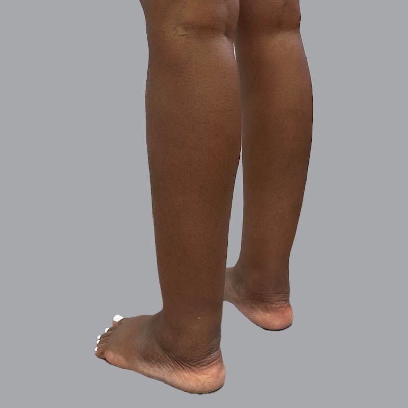 Leg Liposuction Before & After Gallery - Patient 422345 - Image 1
