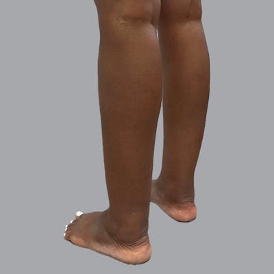 Lipedema Before & After Gallery - Patient 260535 - Image 1
