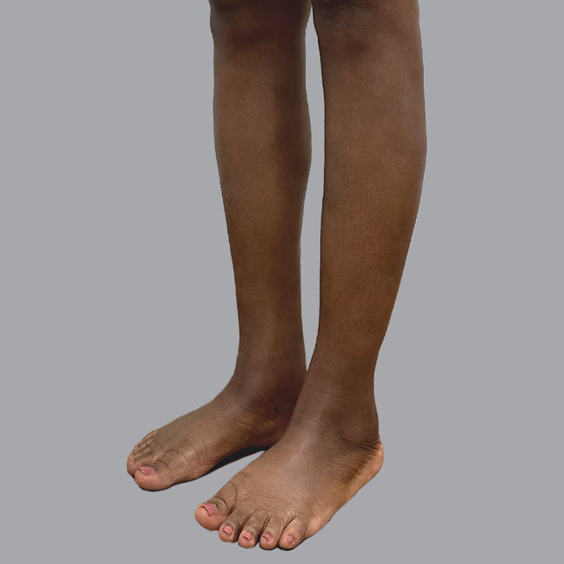 Leg Liposuction Before & After Gallery - Patient 422345 - Image 4