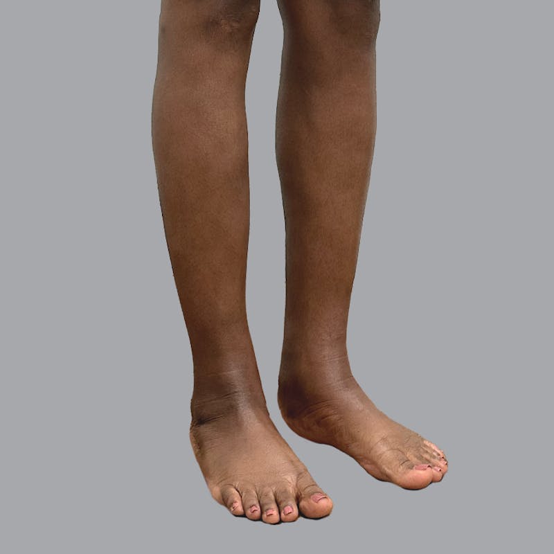 Leg Liposuction Before & After Gallery - Patient 422345 - Image 6