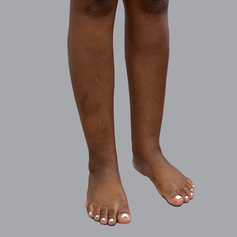 Leg Liposuction Before & After Gallery - Patient 422345 - Image 5