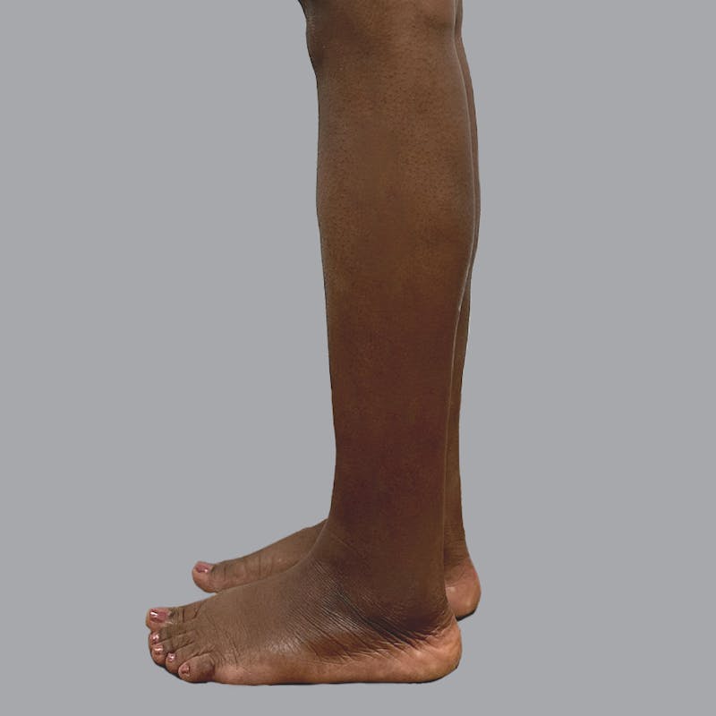 Leg Liposuction Before & After Gallery - Patient 422345 - Image 8