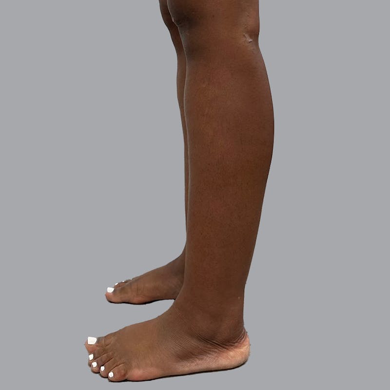Leg Liposuction Before & After Gallery - Patient 422345 - Image 7