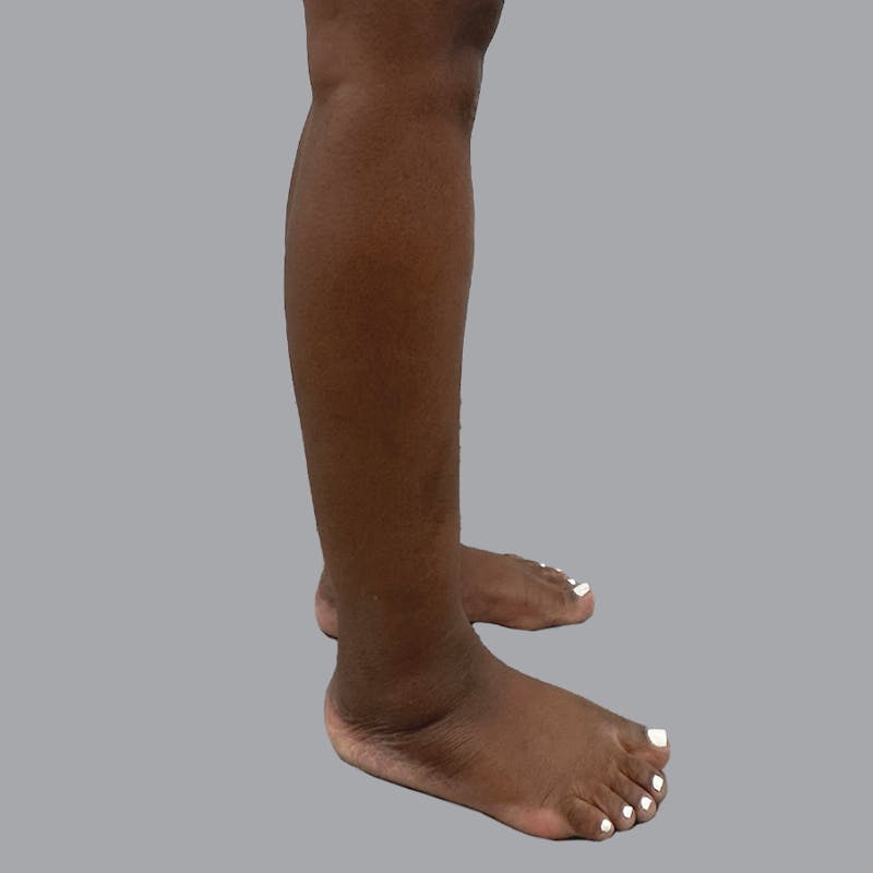 Leg Liposuction Before & After Gallery - Patient 422345 - Image 9