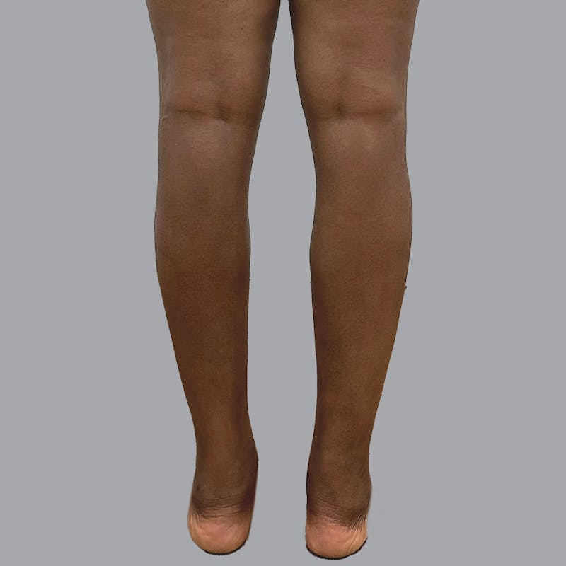 Leg Liposuction Before & After Gallery - Patient 422345 - Image 12
