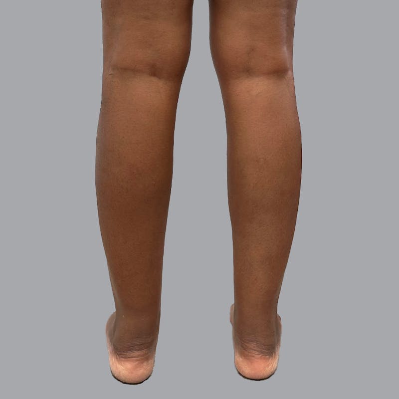 Leg Liposuction Before & After Gallery - Patient 422345 - Image 11