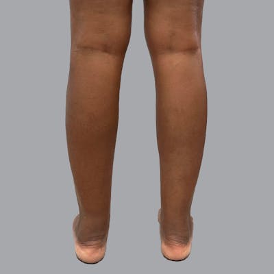 Lipedema Before & After Gallery - Patient 260535 - Image 3