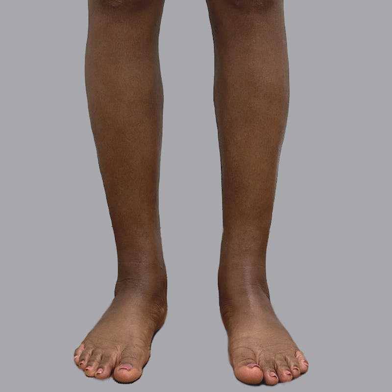 Leg Liposuction Before & After Gallery - Patient 422345 - Image 14