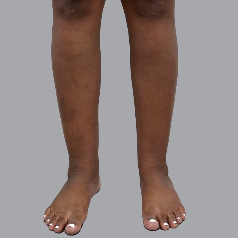 Leg Liposuction Before & After Gallery - Patient 422345 - Image 13