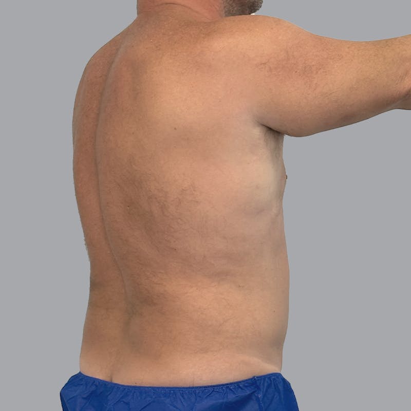 Body Liposuction Before & After Gallery - Patient 362628 - Image 4