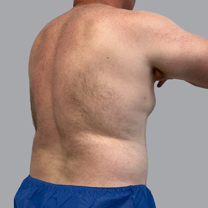 Body Liposuction Before & After Gallery - Patient 362628 - Image 3