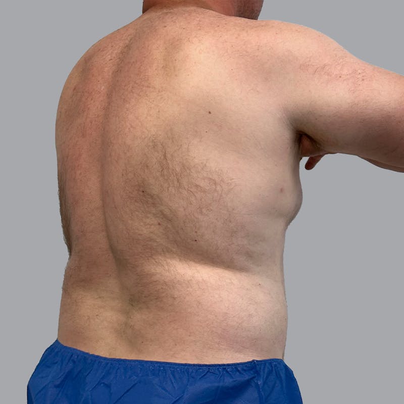 Body Before & After Gallery - Patient 362628 - Image 3