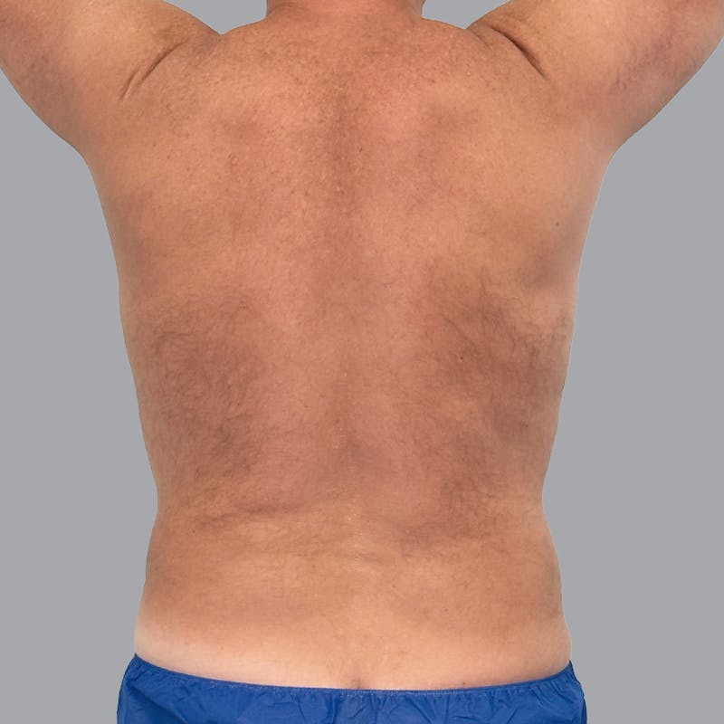 Body Liposuction Before & After Gallery - Patient 362628 - Image 2